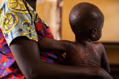 Desde principios de este año, República Centroafricana sufre una epidemia de sarampión, una enfermedad prevenible con vacuna.