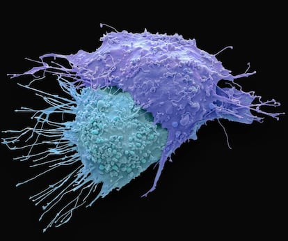 Células de cáncer de ovario vistas con microscopio electrónico.