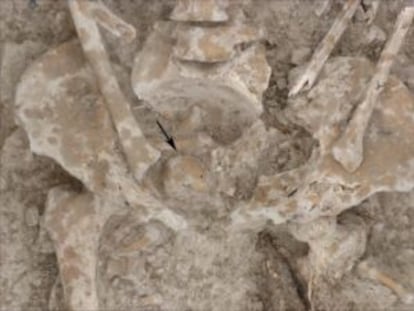 Pelvis del esqueleto que contenía el tumor.