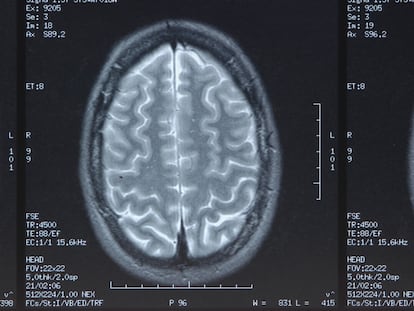 Imagen médica de la sección de un cerebro.