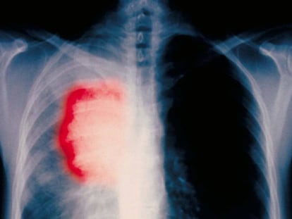 Radiograf&iacute;a de un paciente fumador de 58 a&ntilde;os con c&aacute;ncer de pulm&oacute;n 