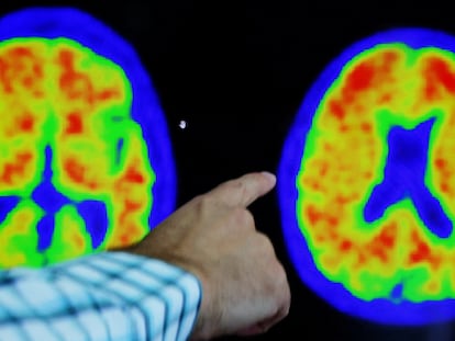 Un médico analiza un escáner cerebral de una persona con alzhéimer.