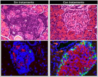 Imagens de microscópio do pâncreas em um animal de teste. Acima: a droga reduz a infiltração de células do sistema imunológico (pontos roxos mais escuros). Abaixo: o medicamento aumenta a produção de insulina (em vermelho)