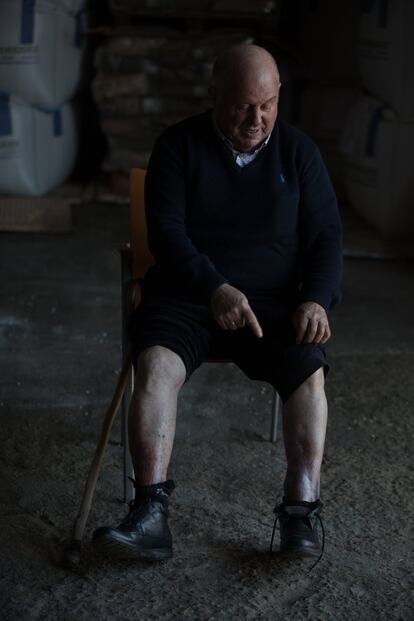 El padre de Domingo Rivas, con el mismo nombre y 71 años, enseña las marcas que conservan sus piernas tras un grave choque en la N-122. Un coche a gran velocidad colisionó con su furgoneta y casi tienen que amputarle una pierna. Ahora cojea pero pude hacer vida con cierta normalidad.