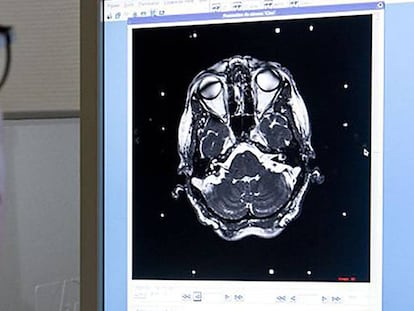 Un médico revisa una prueba diagnóstica del cerebro de un paciente