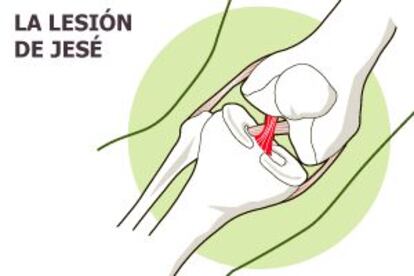 Gráfico del ligamento cruzado de Jesé