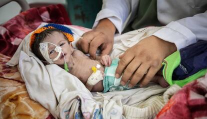 Abdulrazaq Abdulsalam Alsha’abi, un bebé de dos meses que sufre desnutrición grave, es examinado en un hospital de Saná, Yemen, el pasado febrero.