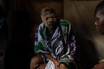 Isaac Namolo de la tribu Gisu, con la cara cubierta de cerveza tras ser circuncidado en el barrio marginal de Kibera en Nairobi (Kenia).