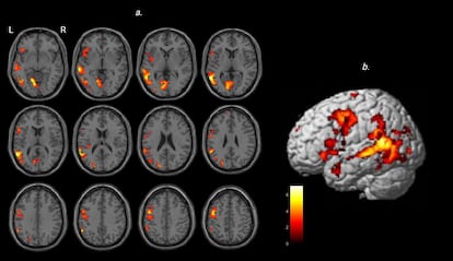 Al interpretar el sarcasmo, se activan en el cerebro múltiples regiones a la vez con conexiones neuronales relacionadas con habilidades sociales.