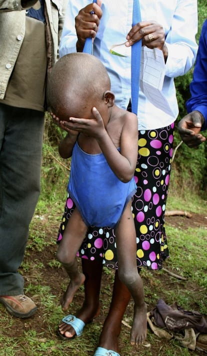 Un ni&ntilde;o con malnutrici&oacute;n es pesado por miembros de la ONG International Medical Corps en Bolossa Sore.