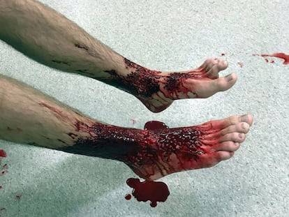 Os pés de Sam Kanizay depois do ataque, em foto tirada por seu pai