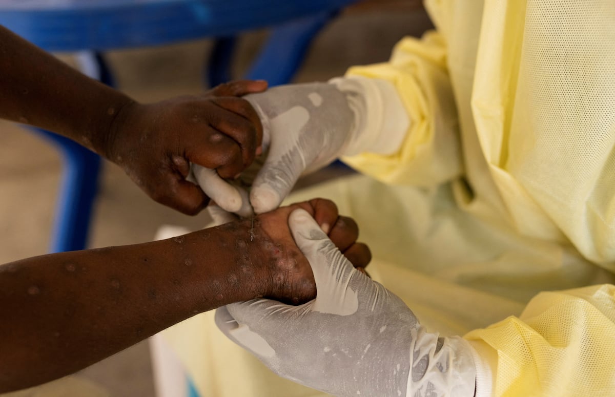 Africa declares health emergency due to monkeypox outbreak | Future Planet