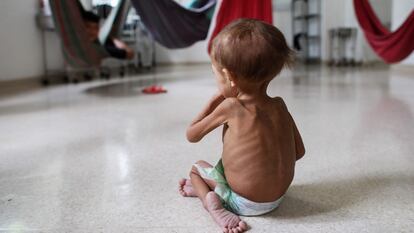 Un niño desnutrido de la etnia yanomami en un hospital pediátrico en Boa Vista, Estado de Roraima (Brasil), el 27 de enero.