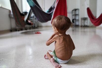 Un niño desnutrido de la etnia yanomami en un hospital pediátrico en Boa Vista, Estado de Roraima (Brasil), el 27 de enero.