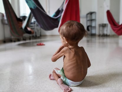 Un niño desnutrido de la etnia yanomami en un hospital pediátrico en Boa Vista, Estado de Roraima (Brasil), el 27 de enero.