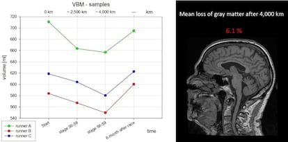 Parte del estudio presentado en el último Congreso Anual de Radiología, donde los científicos del Hospital Universitario de Ulm probaron la pérdida de masa cerebral después de una larga carrera (y su posterior recuperación).