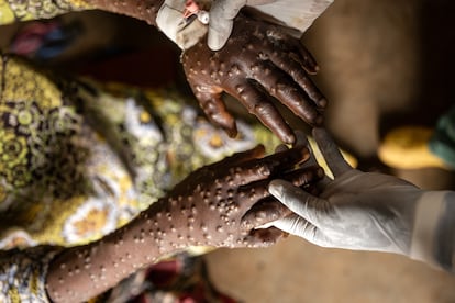 Un paciente de mpox recibía tratamiento el martes en el hospital de Kavumu, en Karanrhada, en la provincia congoleña de Kivu del Sur.