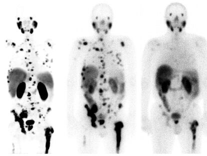 Respuesta a la teragnosis con lutecio-177 en un cáncer de próstata con metástasis, en el Hospital Universitario de Heidelberg (Alemania).