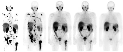 Respuesta a la teragnosis con lutecio-177 en un cáncer de próstata con metástasis, en el Hospital Universitario de Heidelberg (Alemania).