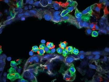 Unos neutrófilos (en verde), de las primeras células inmunitarias que reaccionan en el organismo, se infiltran en un pulmón dañado.