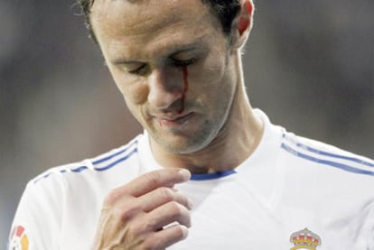 Carvalho se retira sangrando por un ojo.