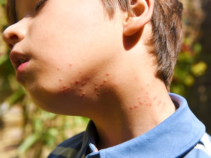 Las reacciones por alergia a veneno de los insectos varían desde una reacción local hasta un cuadro anafiláctico, potencialmente mortal. 