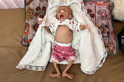Zainab Abu Haleeb, una niña palestina de cinco meses completamente desnutrida, recibe tratamiento en el hospital Nasser en Jan Yunis.