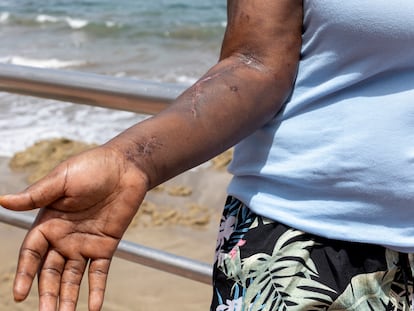 Heridas de bala en el brazo de Ángela (nombre ficticio), una ghanesa que fue tiroteada en una zódiac cuando salió de Bojador (Sahara) el 23 de mayo.