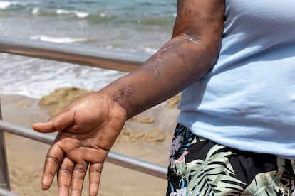 Heridas de bala en el brazo de Ángela (nombre ficticio), una ghanesa que fue tiroteada en una zódiac cuando salió de Bojador (Sahara) el 23 de mayo.