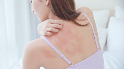 Artículo de EL PAÍS Escaparate que describe las mejores cremas y bálsamos para calmar la urticaria.