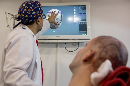 Un doctor explica a un paciente el proceso de implante capilar en una clínica de Turquía, que se ha hecho mundialmente conocida como destino vacacional y, desde hace unos años, como destino para implantarse cabello