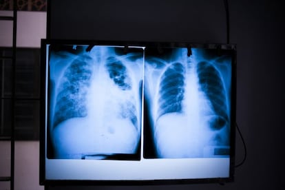 Radiografía de los pulmones de un paciente sano (derecha) frente a los pulmones de un paciente infectado de tuberculosis (izquierda). Camboya ocupa el segundo lugar del mundo en lo que se refiere a la prevalencia de esta enfermedad, con 800 personas de cada 100.000 infectadas con TB activa. Cada año se infectarán 60.000 personas aproximadamente. El problema es que el sistema de salud existente sólo identificará a entre 25.000 y 30.000 personas, lo que provoca un gran vacío en la detección de la enfermedad.