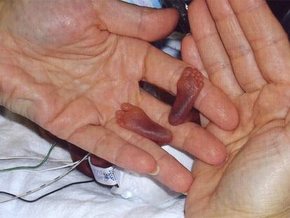 El nacimiento en 2006 de Amillia Taylor en Miami, con menos de 22 semanas de embarazo, fue un <i>milagro</i> del avance de la medicina.