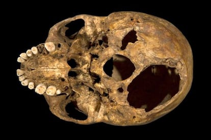 Una imagen de la calavera de Ricardo III, que muestra las heridas que acabaron con su vida.