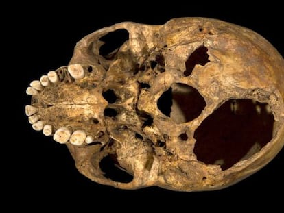 Una imagen de la calavera de Ricardo III, que muestra las heridas que acabaron con su vida. 