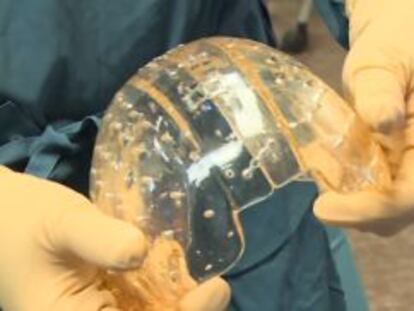 El implante creaneal impreso en 3D.