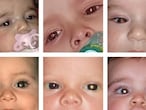 Retinoblastoma niños