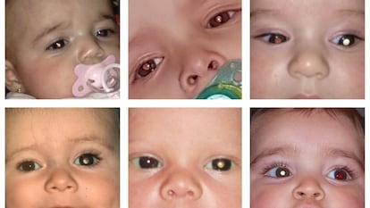 Retinoblastoma niños