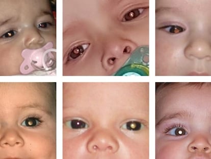 El retinoblastoma es el tercer cáncer infantil más frecuente en niños. Foto cedida por la Asociación Española de Retinoblastoma.