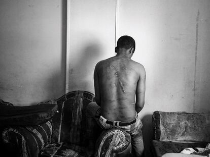 Un solicitante de asilo eritreo en El Cairo muestra su espalda con cicatrices. Los traficantes egipcios lo torturaron goteando plástico fundido en su espalda para pedir un rescate en la península del Sinaí en mayo de 2013.