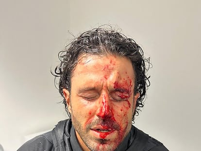 El entrenador del Olympique de Lyon, Fabio Grosso, herido en un ojo tras el ataque de radicales del Marsella al autobús del equipo.