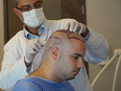 El cirujano Abdullah Et&ouml;z se&ntilde;ala las zonas de la cabeza de su paciente de las que se extraer&aacute;n los fol&iacute;culos capilares que se implantar&aacute;n en la parte superior.