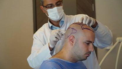 El cirujano Abdullah Et&ouml;z se&ntilde;ala las zonas de la cabeza de su paciente de las que se extraer&aacute;n los fol&iacute;culos capilares que se implantar&aacute;n en la parte superior.