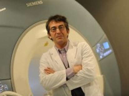 ¿Qué ocurre en nuestro cerebro antes de padecer alzhéimer?