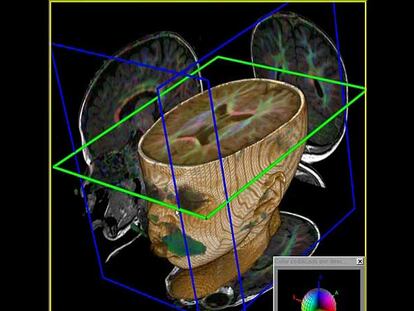 Resonancia magnética del cerebro de un niño de 12 meses.