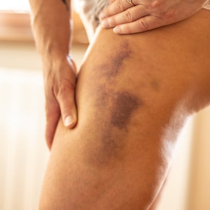 A bruise on the leg of an unidentified woman of thrombotic charachter. A blood clot on the leg of a woman with hemophilia