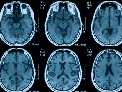 Inteligencia artificial y música para la recuperación de pacientes con ictus