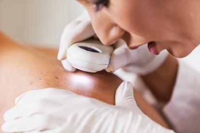 El cáncer de piel se clasifica en melanoma y carcinoma. En España se diagnostican 78.000 nuevos casos al año.