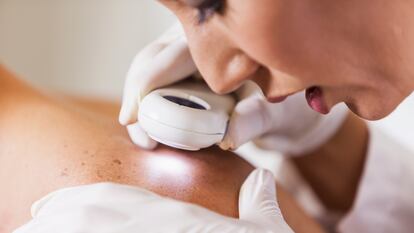 El cáncer de piel se clasifica en melanoma y carcinoma. En España se diagnostican 78.000 nuevos casos al año.