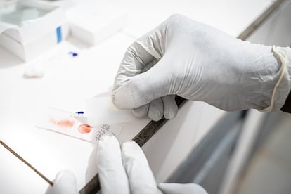 Biolog Fakouma Camara przygotowuje próbkę krwi do badania pod mikroskopem. Pozwoli to ustalić obecność pasożytów wywołujących malarię.